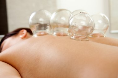 Cupping/ventouses